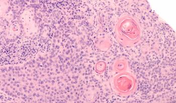 Photomicrograph of a CT (CAT) scan-guided needle core biopsy showing pulmonary squamous cell carcinoma, a type of non-small cell carcinoma usually associated with smoking