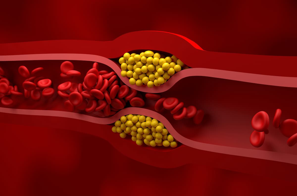 Partly blocked vessel in high level of LDL (bad cholesterol) lipoprotein – isometric view 3d illustration