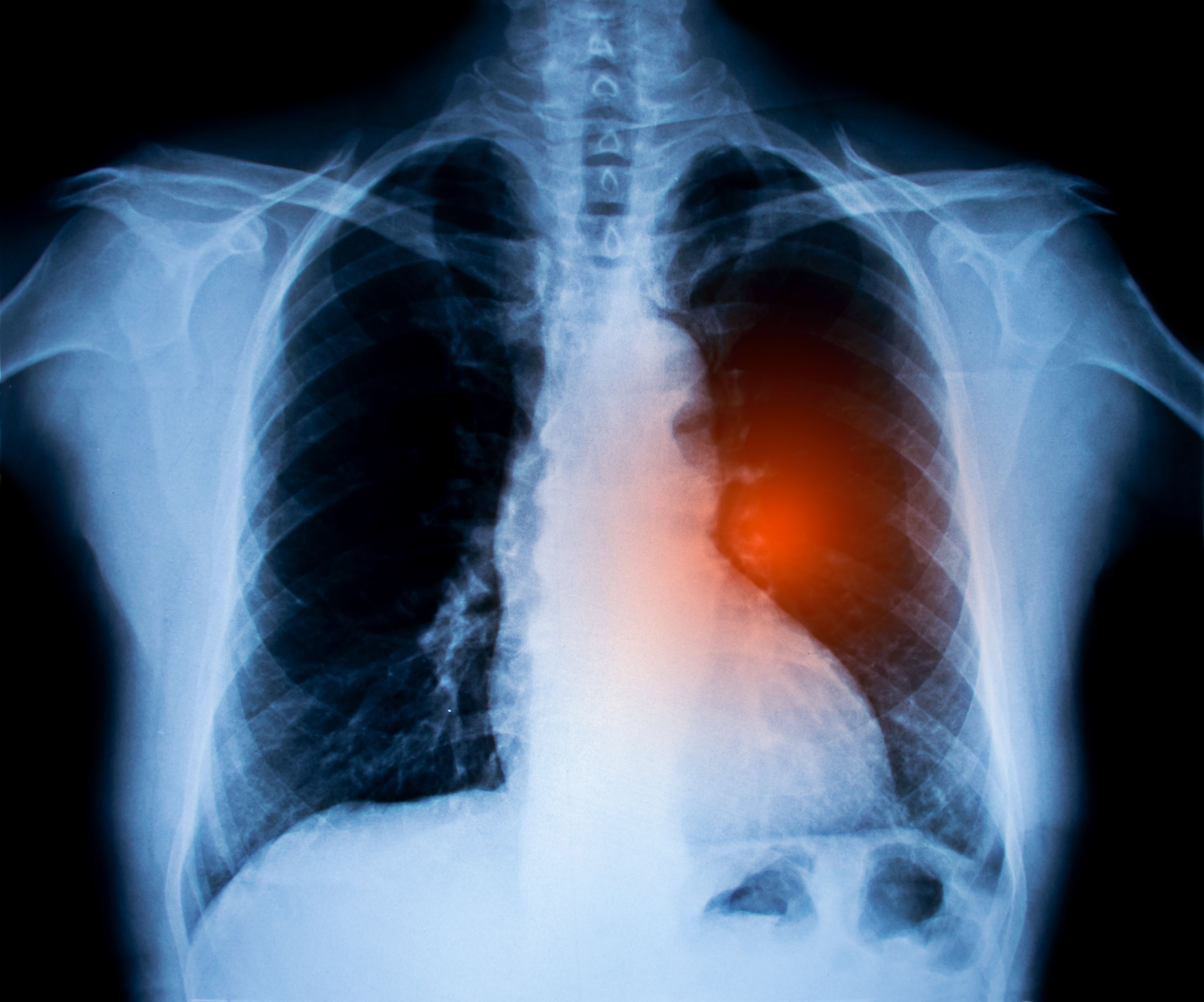Novel Chemotherapy Method Could Decrease Lung Cancer Tumor S
