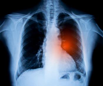 X-ray image of chest. Lung cancer concept - Image credit: cunaplus | stock.adobe.com