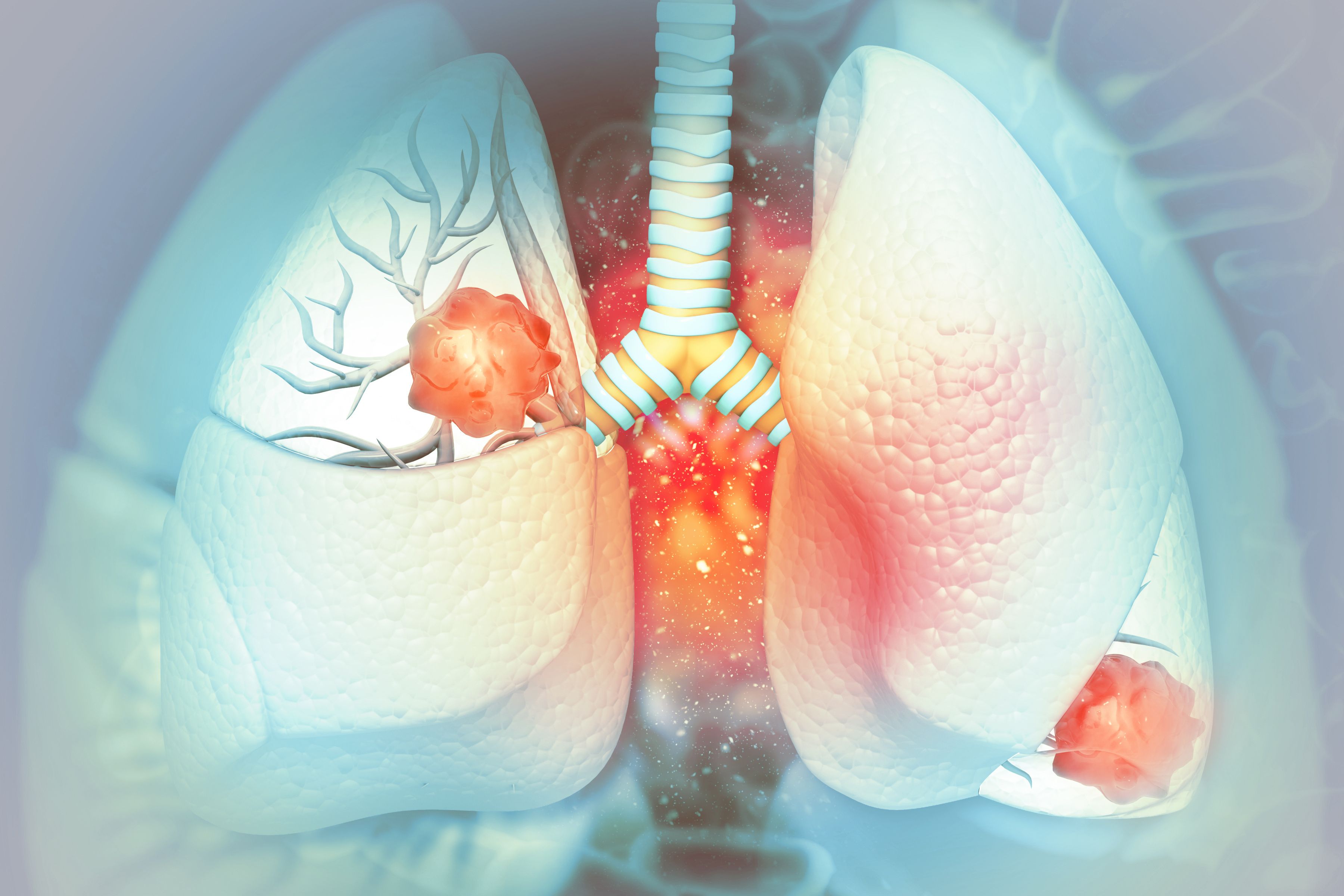 Non–small cell lung cancer (NSCLC) -- Image credit: Crystal light | stock.adobe.com
