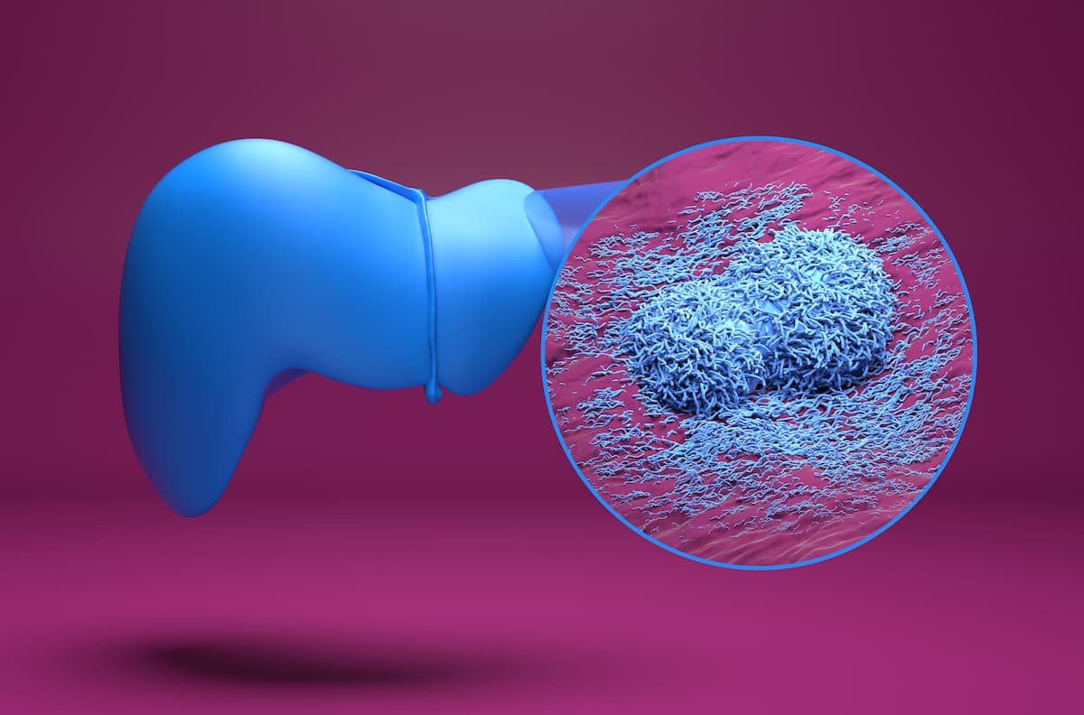 Liver cancer - isometric view 3d illustration