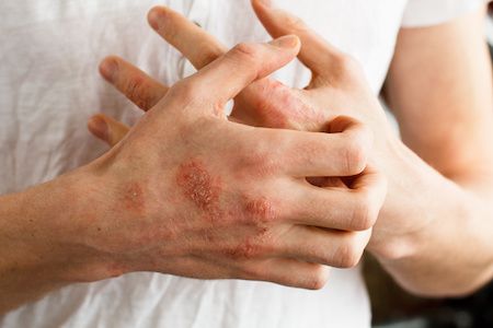 Analysis: Dupilumab Improves Quality of Life for Patients With Atopic Dermatitis