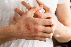 Analysis: Dupilumab Improves Quality of Life for Patients With Atopic Dermatitis