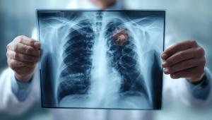 Osimertinib, Savolitinib Improve PFS and OS in MET-Driven EGFR-Mutated NSCLC