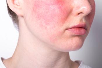 Woman with rosacea -- Image credit: iso100production | stock.adobe.com