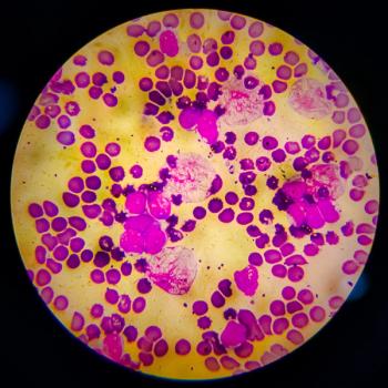 Multiple myeloma -- Image credit: Arif Biswas | stock.adobe.com