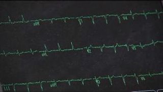 Holiday Heart Syndrome