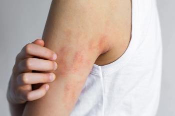 Child scratching irritated elbow with visible atopic dermatitis eczema symptoms, dry red patches on sensitive skin, chronic allergy condition, pediatric dermatology problem, itching discomfort concept - Image credit: Evgeniia Primavera | stock.adobe.com
