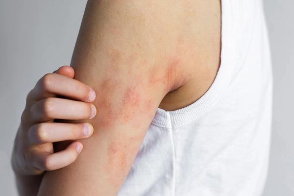 Child scratching irritated elbow with visible atopic dermatitis eczema symptoms, dry red patches on sensitive skin, chronic allergy condition, pediatric dermatology problem, itching discomfort concept - Image credit: Evgeniia Primavera | stock.adobe.com