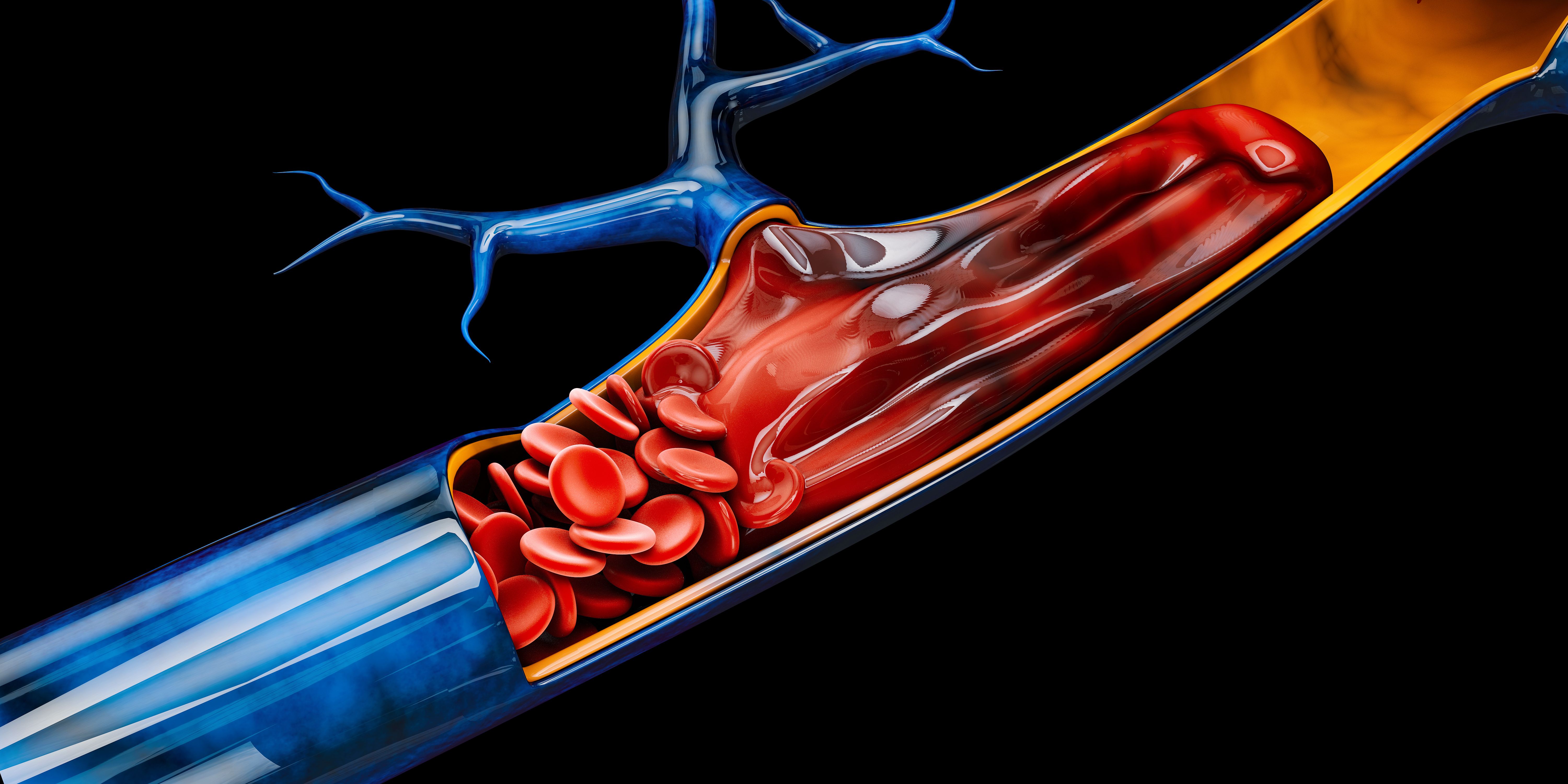 API-CAT Findings Support Existing NCCN Cancer-Associated VTE Guidance