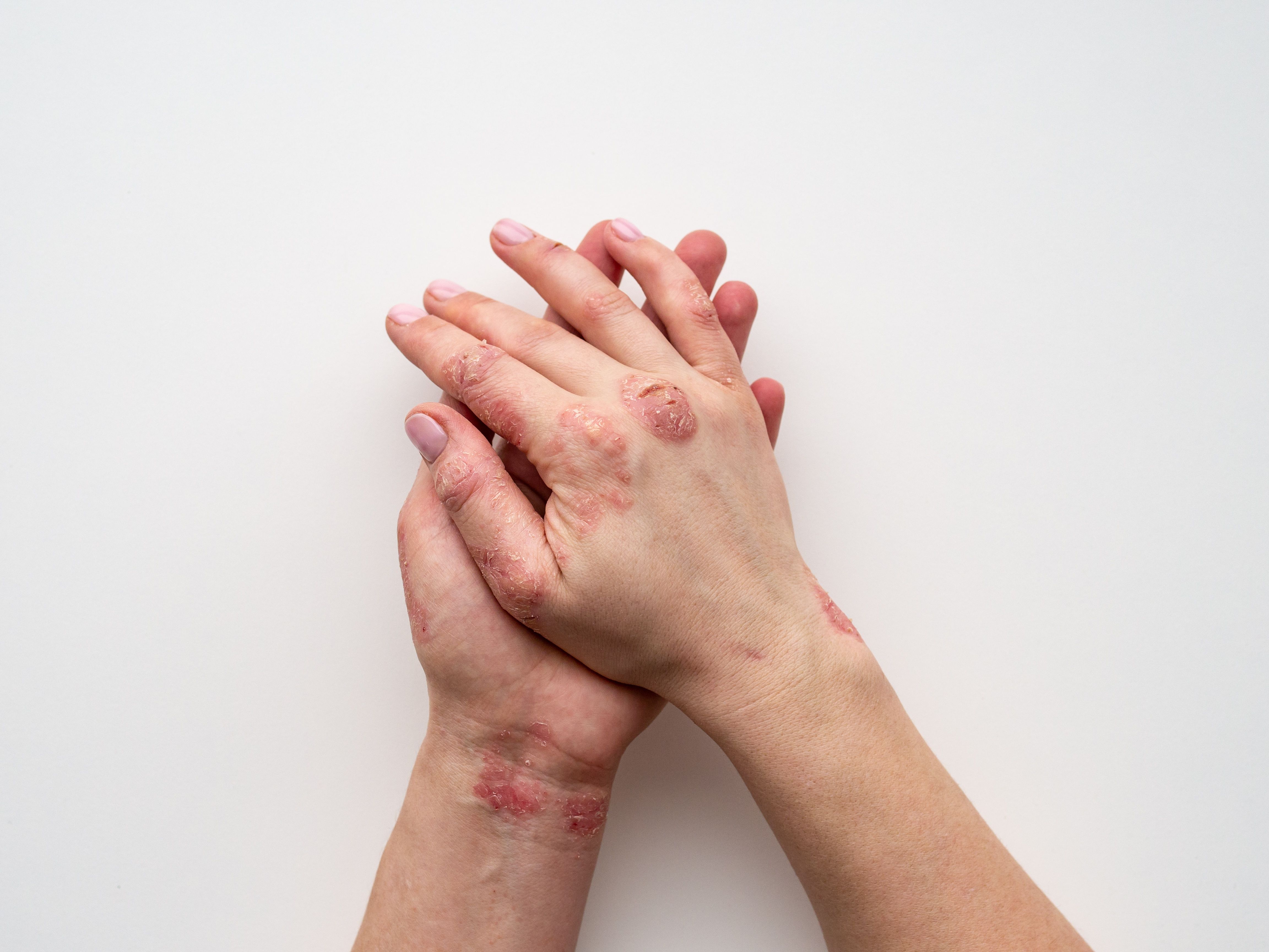 Psoriasis skin. Closeup of rash and scaling on the patient's skin. The concept of chronic disease treatment. Dermatological problems. Hard and cracked skin in woman's hands. Dry skin. Isolated - Image credit: IIIRusya | stock.adobe.com