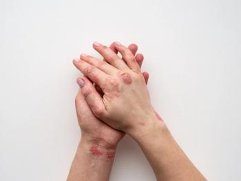 Psoriasis skin. Closeup of rash and scaling on the patient's skin. The concept of chronic disease treatment. Dermatological problems. Hard and cracked skin in woman's hands. Dry skin. Isolated - Image credit: IIIRusya | stock.adobe.com