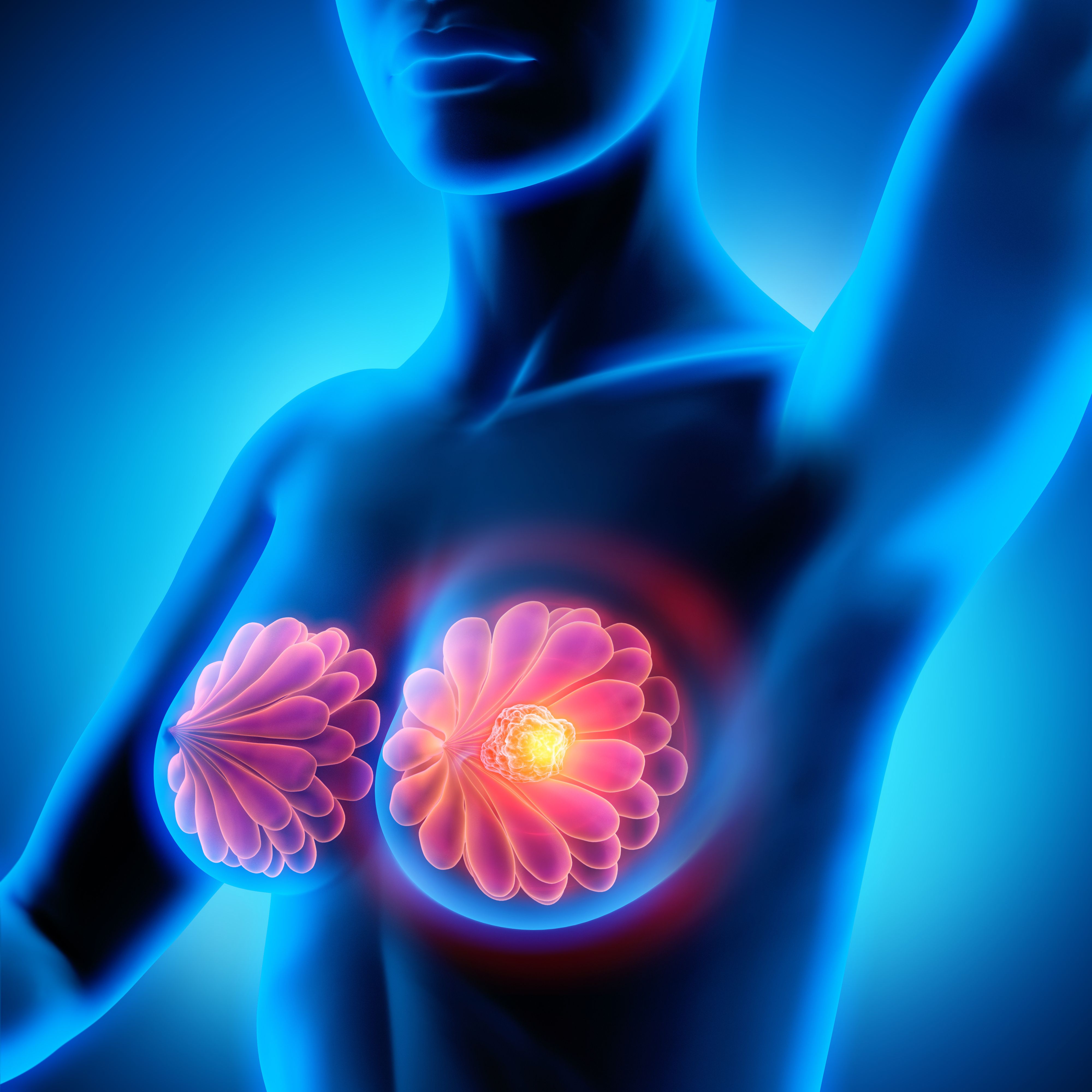 X-ray of tumor on a patient's breast -- Image credit: peterschreiber.media | stock.adobe.com