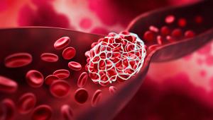 Blood clot blocking a blood vessel -- Image credit: peterschreiber.media | stock.adobe.com