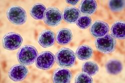 The Role of Setting in Patient Care During the Treatment of Burkitt Lymphoma