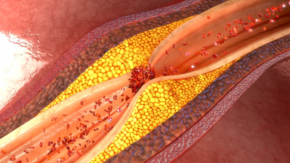 Coronary artery plaque