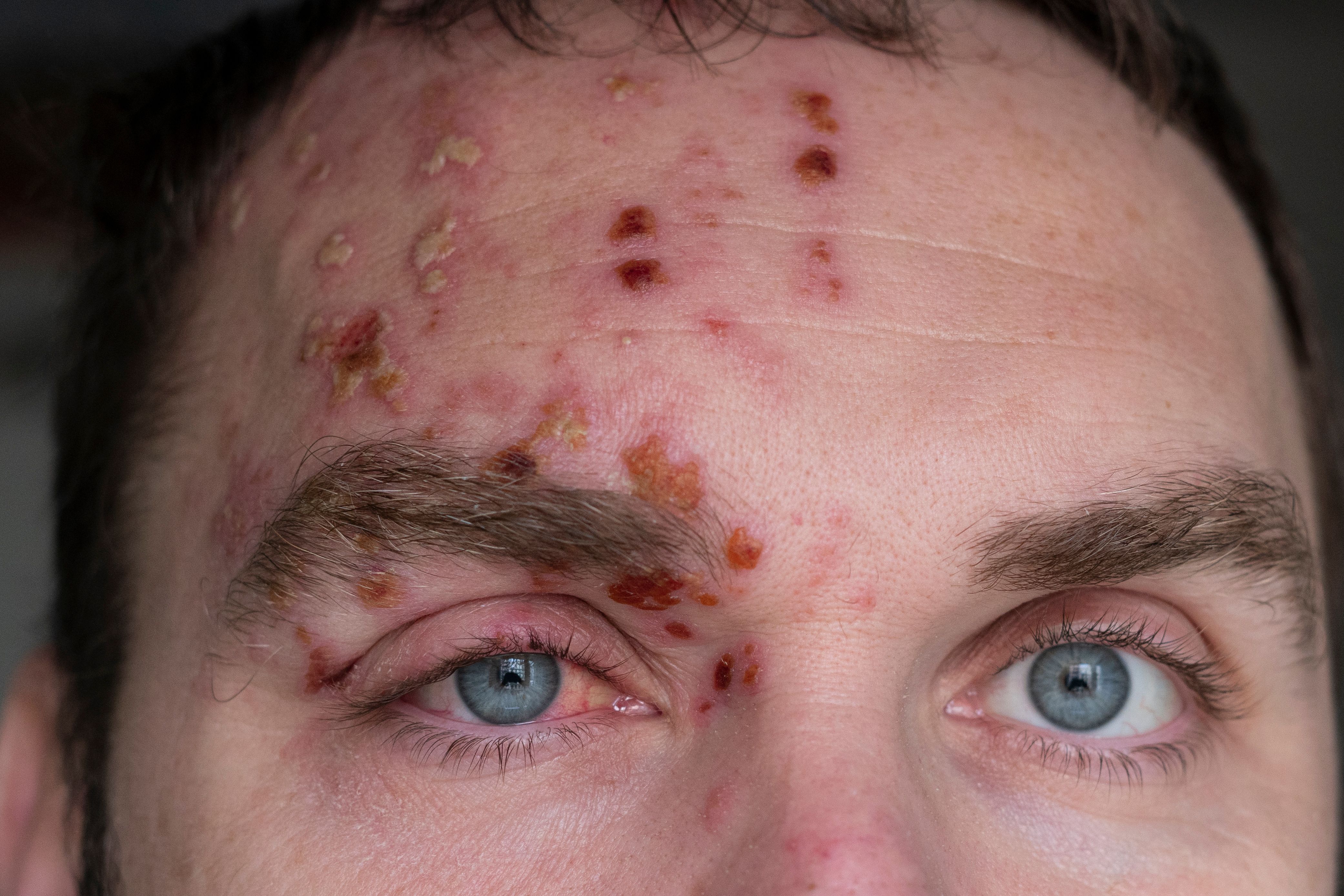 Man with Herpes Zoster (shingles) on the face, close up. Inflamed eyelid and red eye of a man suffering from herpes on the face. Purulent blisters on the face during Shingles - Image credit: Yury | stock.adobe.com