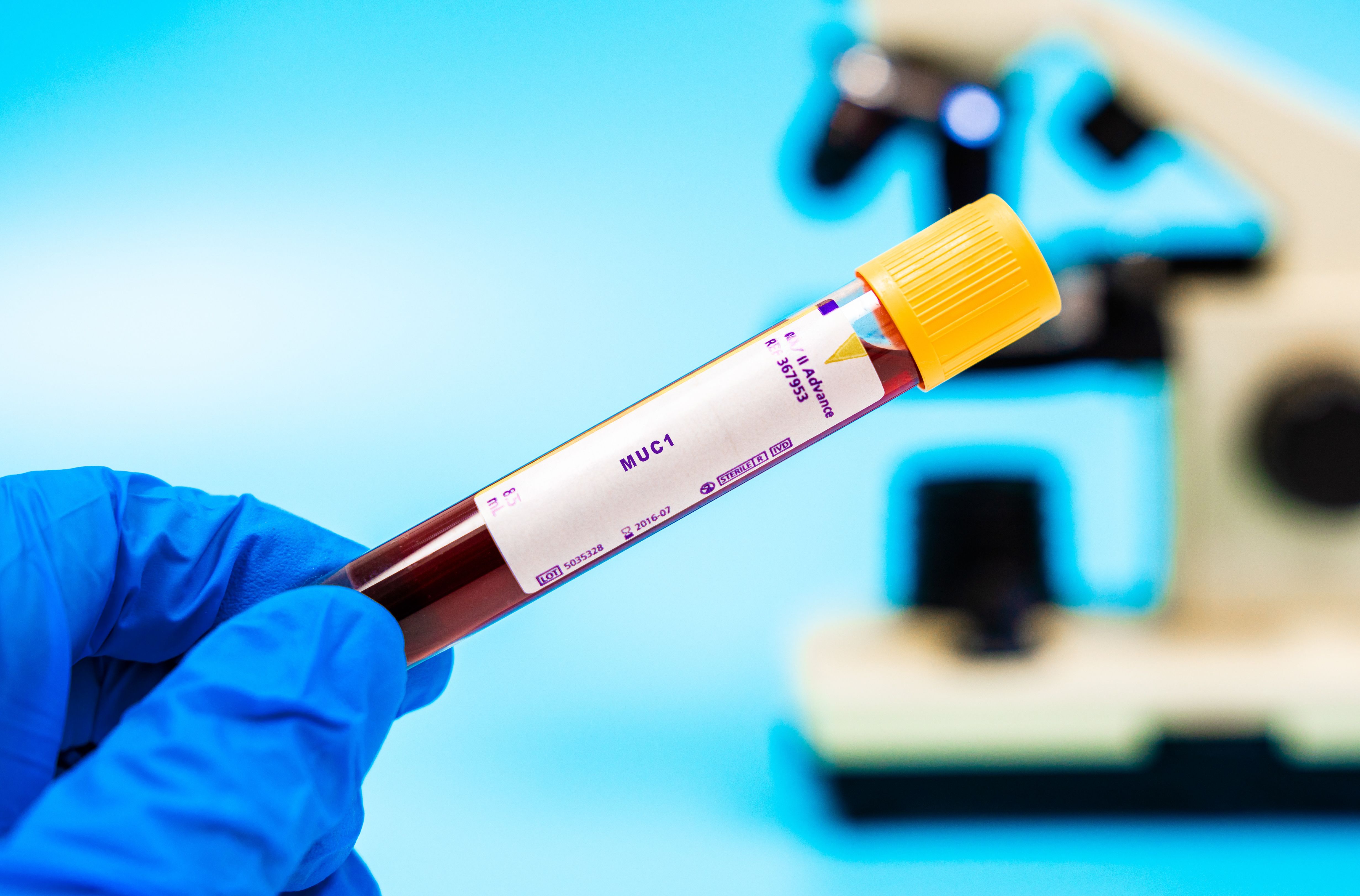Blood sample vial testing MUC1 levels | Image Credit: © luchschenF - stock.adobe.com