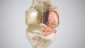healthy knee and osteoarthritis knee in comparison - high degree of detail - Image credit: crevis | stock.adobe.com