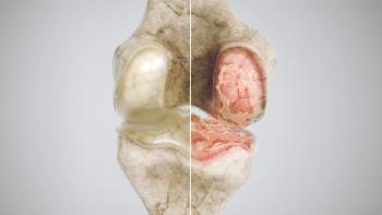 healthy knee and osteoarthritis knee in comparison - high degree of detail - Image credit: crevis | stock.adobe.com
