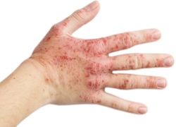 Study Suggests PCSK9 Inhibitors May Lower Risk of Psoriasis
