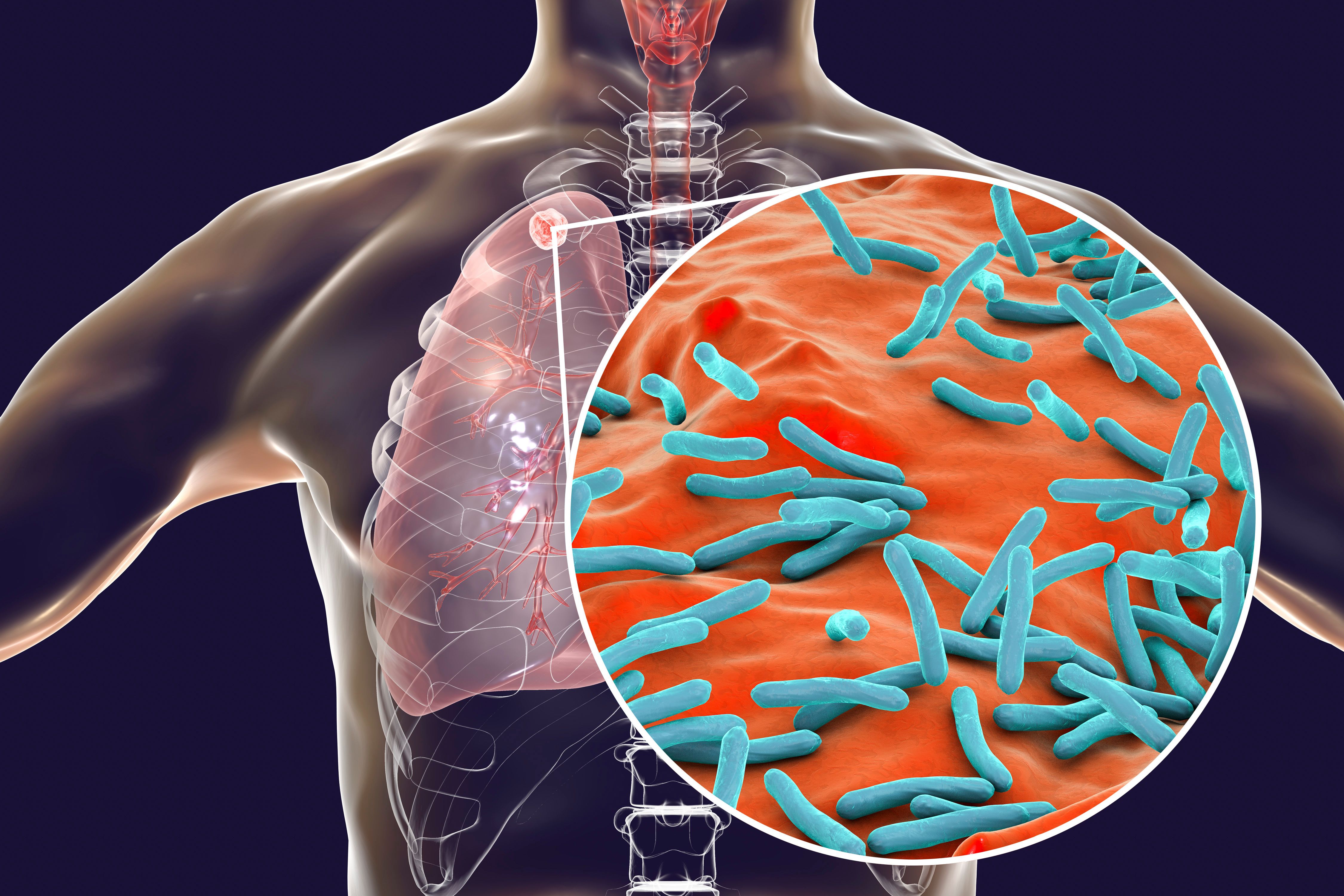 Secondary tuberculosis in lungs and close-up view of Mycobacterium tuberculosis bacteria, 3D illustration - Image credit: Dr_Microbe | stock.adobe.com
