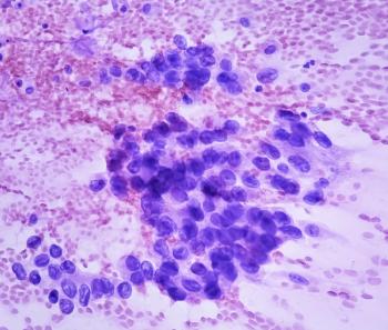 Photomicrograph of fine needle aspiration (FNA) cytology of a pulmonary (lung) nodule showing adenocarcinoma, a type of non small cell carcinoma. | Image Credit: Saiful52 | stock.adobe.com