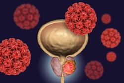 Study: Hormone Therapy Increases Survival Rate for Men With Prostate Cancer