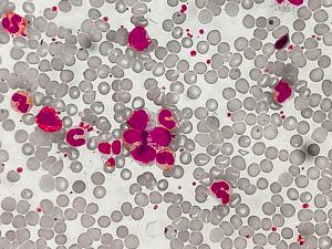 Zanubrutinib Improves PFS2, Maintains Sensitivity to Subsequent Therapy in Frontline CLL/SLL