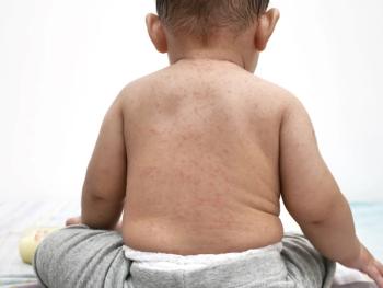 Infant with measles spot on back | Image Credit: © airdone - stock.adobe.com