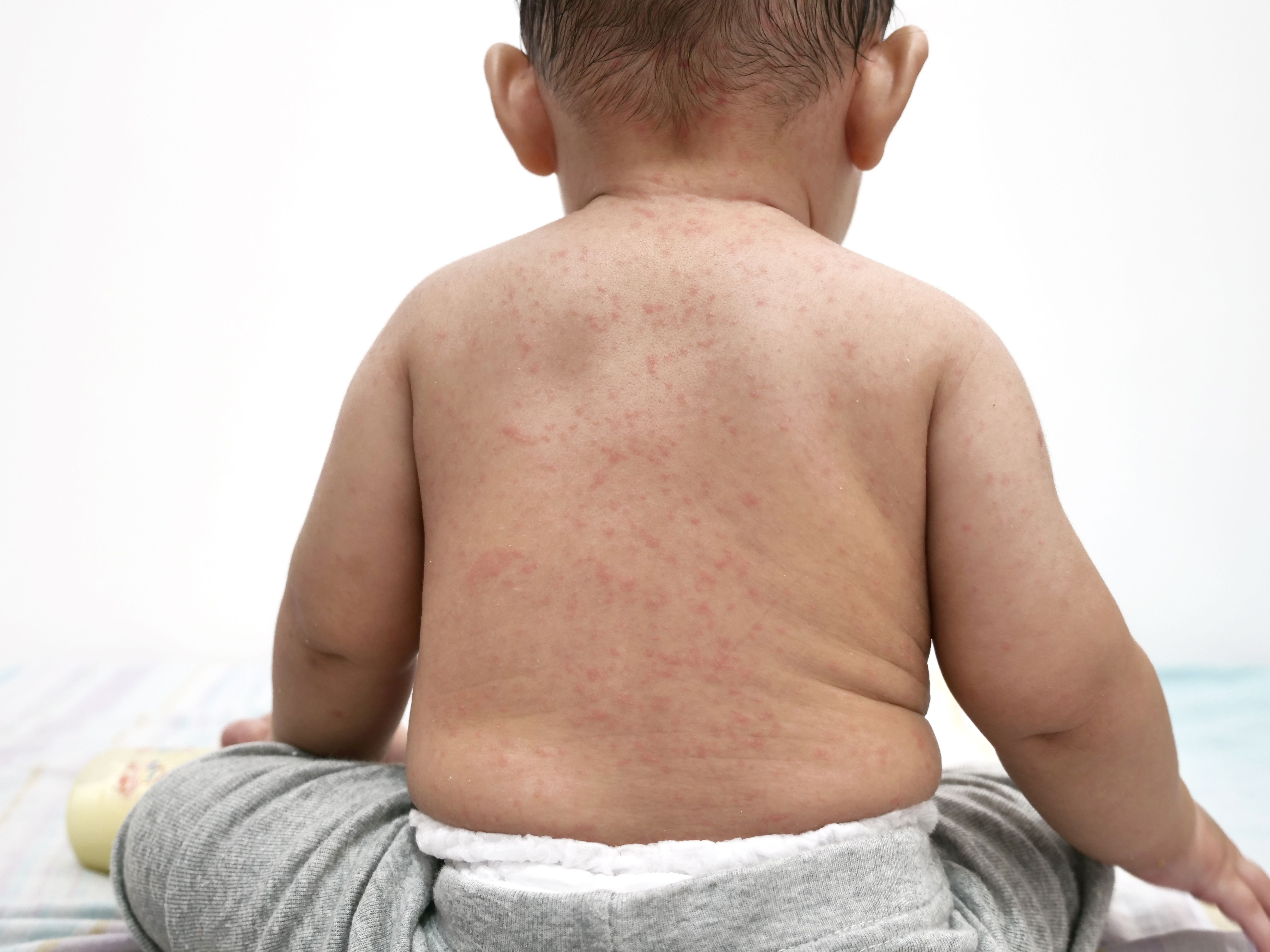 Rare Measles Complication Linked to Past Infection – Los Angeles Case Rare Measles Complication Linked to Past Infection – Los Angeles Case