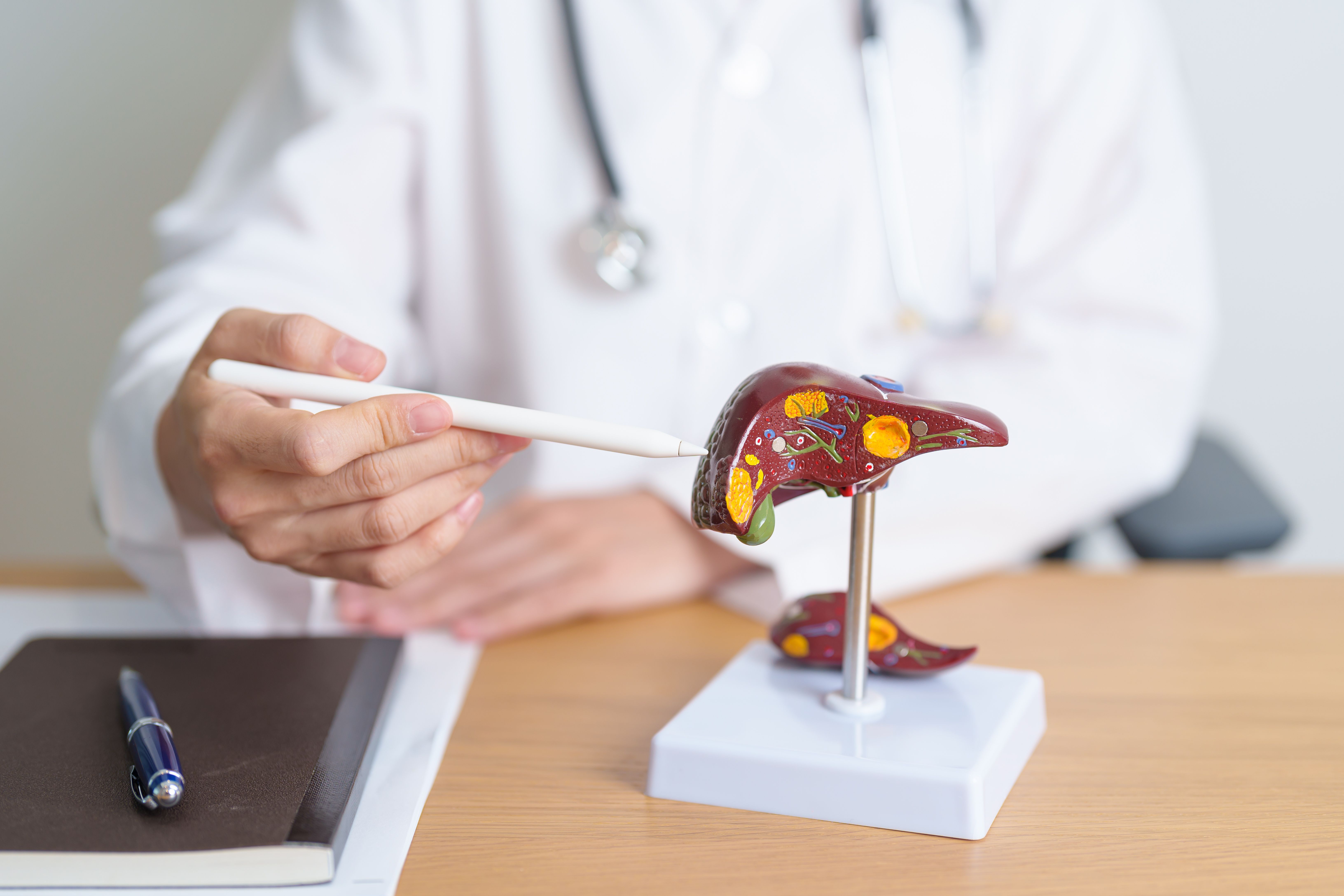 Doctor with human Liver anatomy model. Liver cancer and Tumor, Jaundice, Viral Hepatitis A, B, C, D, E, Cirrhosis, Failure, Enlarged, Hepatic Encephalopathy, Ascites Fluid in Belly and health concept - Image credit: Jo Panuwat D | stock.adobe.com 