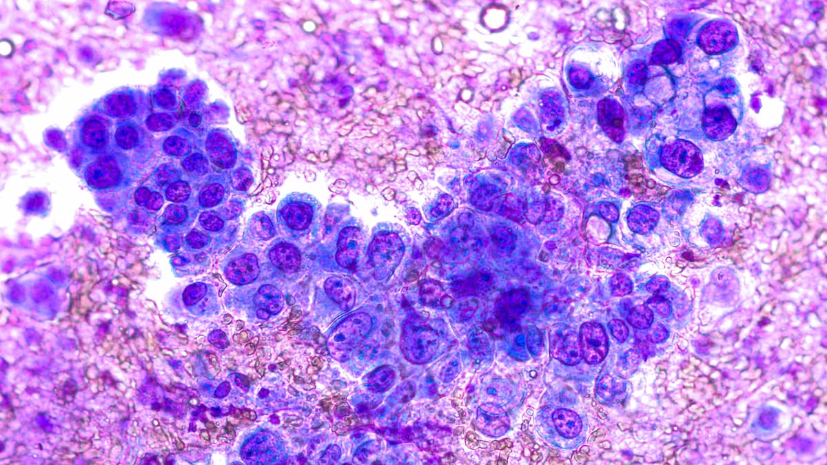 Phogomicrograph of fine needle aspiration (FNA) cytology of a pulmonary (lung) nodule showing adenocarcinoma, a type of non small cell carcinoma.