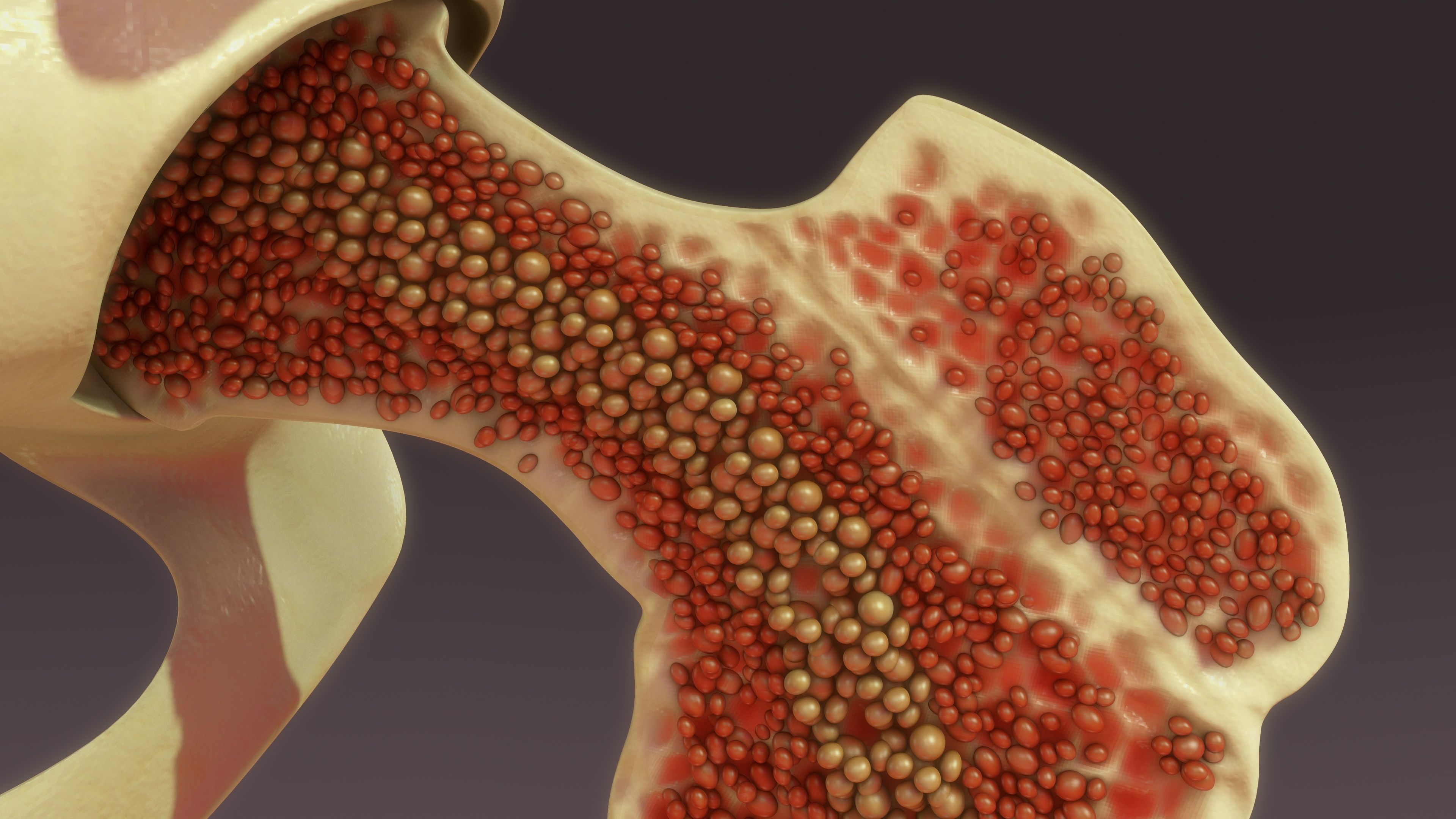 bone marrow multiple myeloma