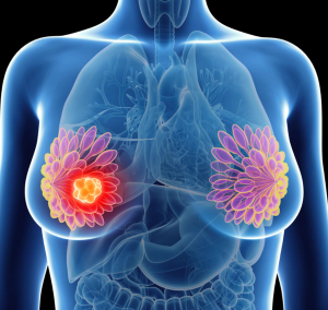 Oncology Overview: Abemaciclib (Verzenio) for HR-Positive, HER2-Negative High Risk Early Breast Cancer 