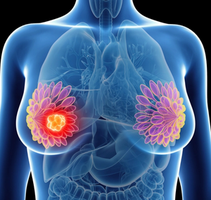 Oncology Overview: Abemaciclib (Verzenio) for HR-Positive, HER2-Negative High Risk Early Breast Cancer