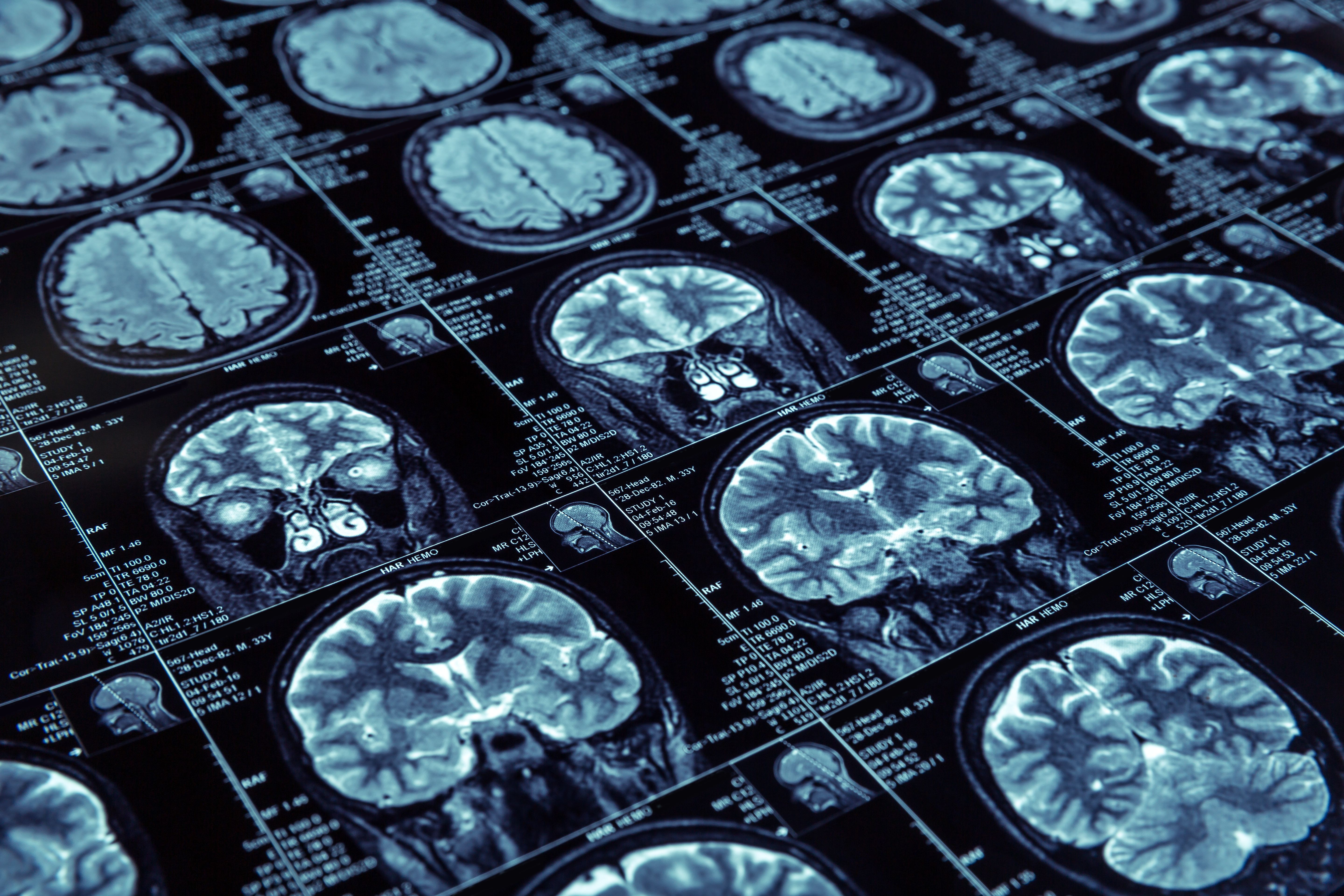 Brain scans, Alzheimer disease -- Image credit: Nomad_Soul | stock.adobe.com