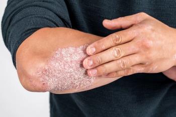 Patient with plaque psoriasis -- Image credit: fusssergei | stock.adobe.com