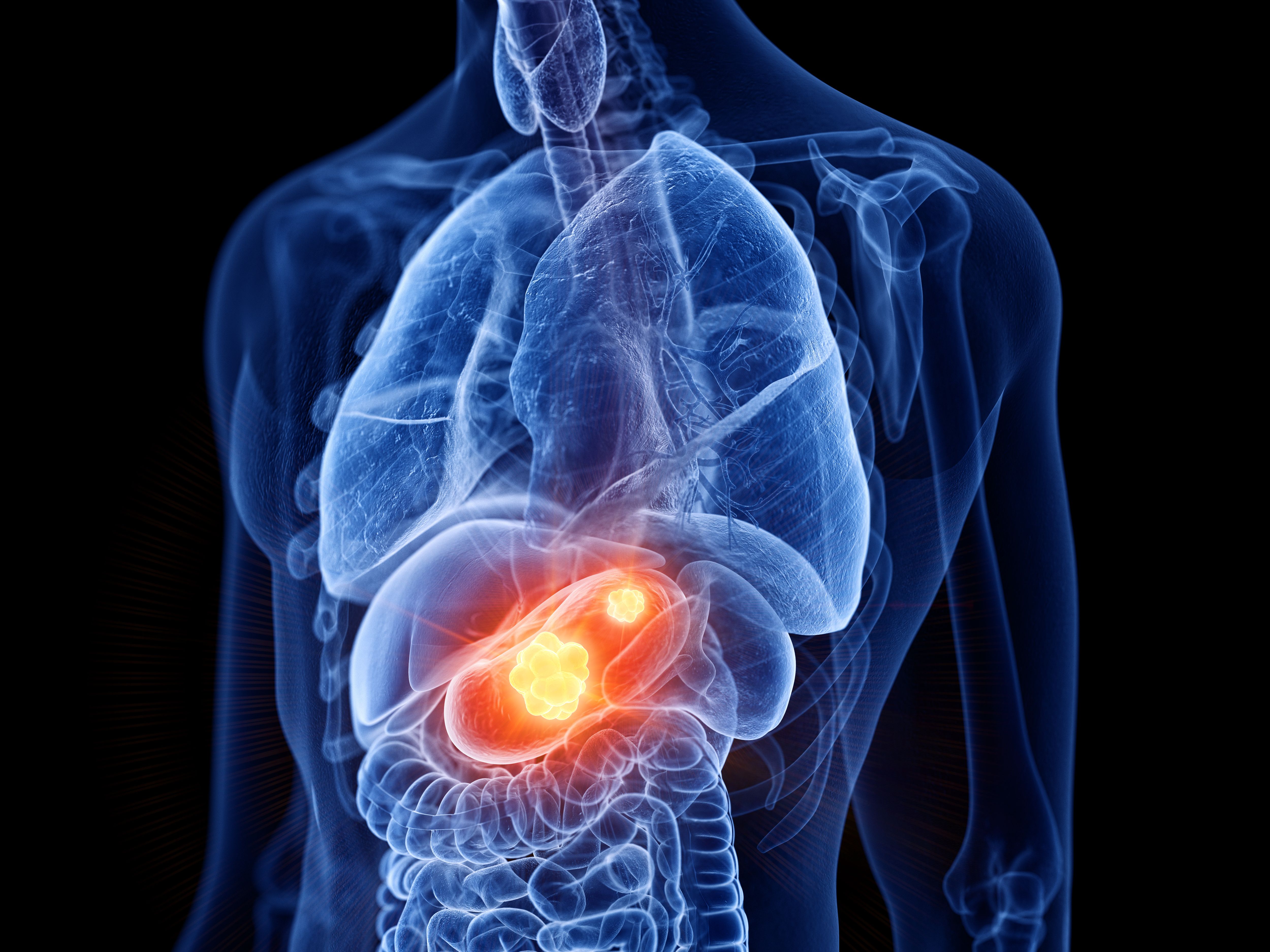 3d rendered medically accurate illustration of stomach cancer - Image credit: Sebastian Kaulitzki | stock.adobe.com 