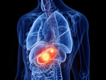 3d rendered medically accurate illustration of stomach cancer - Image credit: Sebastian Kaulitzki | stock.adobe.com 