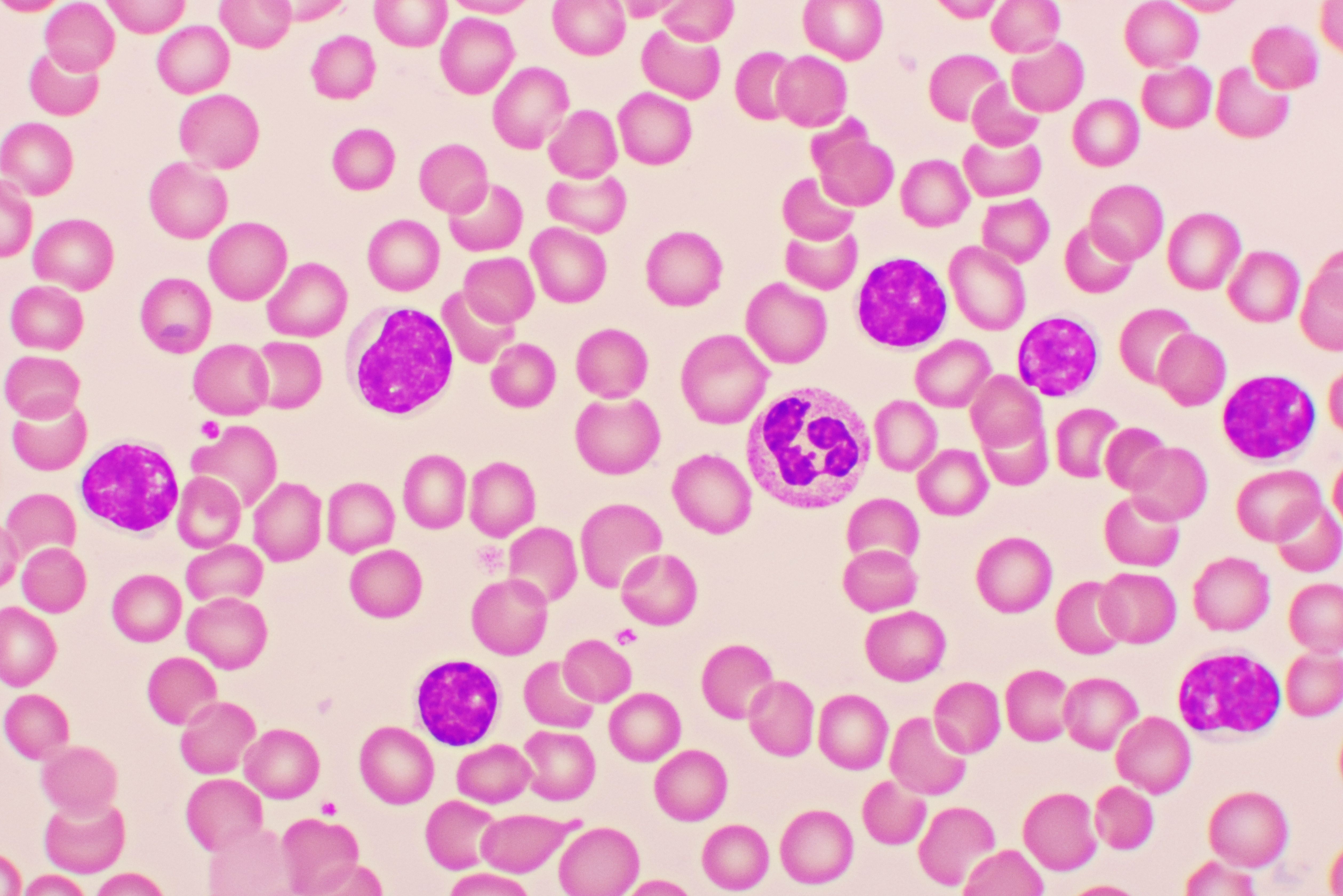 Blood under microscope showing CLL cells | Image Credit: © jarun011 - stock.adobe.com