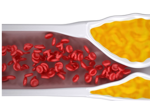 Repatha: A Lipid-lowering Monoclonal Antibody