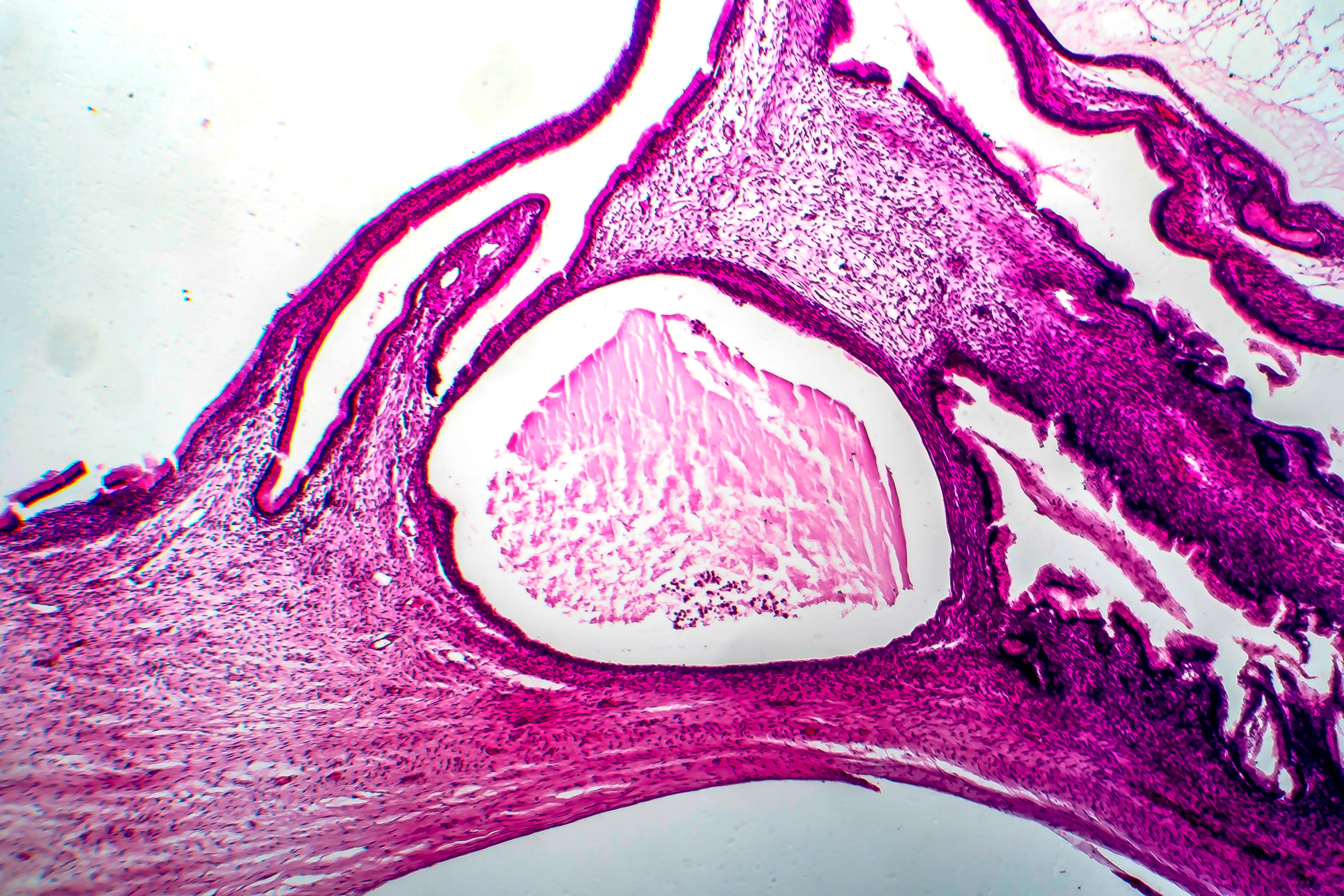 Ovarian cancer -- Image credit: Dr_Microbe | stock.adobe.com