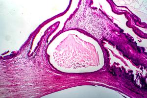 Ovarian cancer -- Image credit: Dr_Microbe | stock.adobe.com
