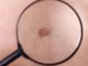 Is that a Spot? Self-Screening for Skin Cancer