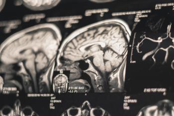 Brain with Parkinson disease -- Image credit: Vadym | stock.adobe.com