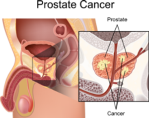 Current Treatment Modalities, Available Therapeutics for Prostate Cancer See Growth