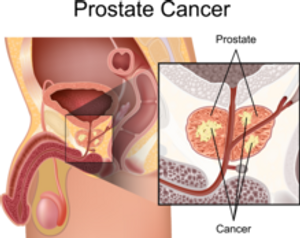 Current Treatment Modalities, Available Therapeutics for Prostate Cancer See Growth