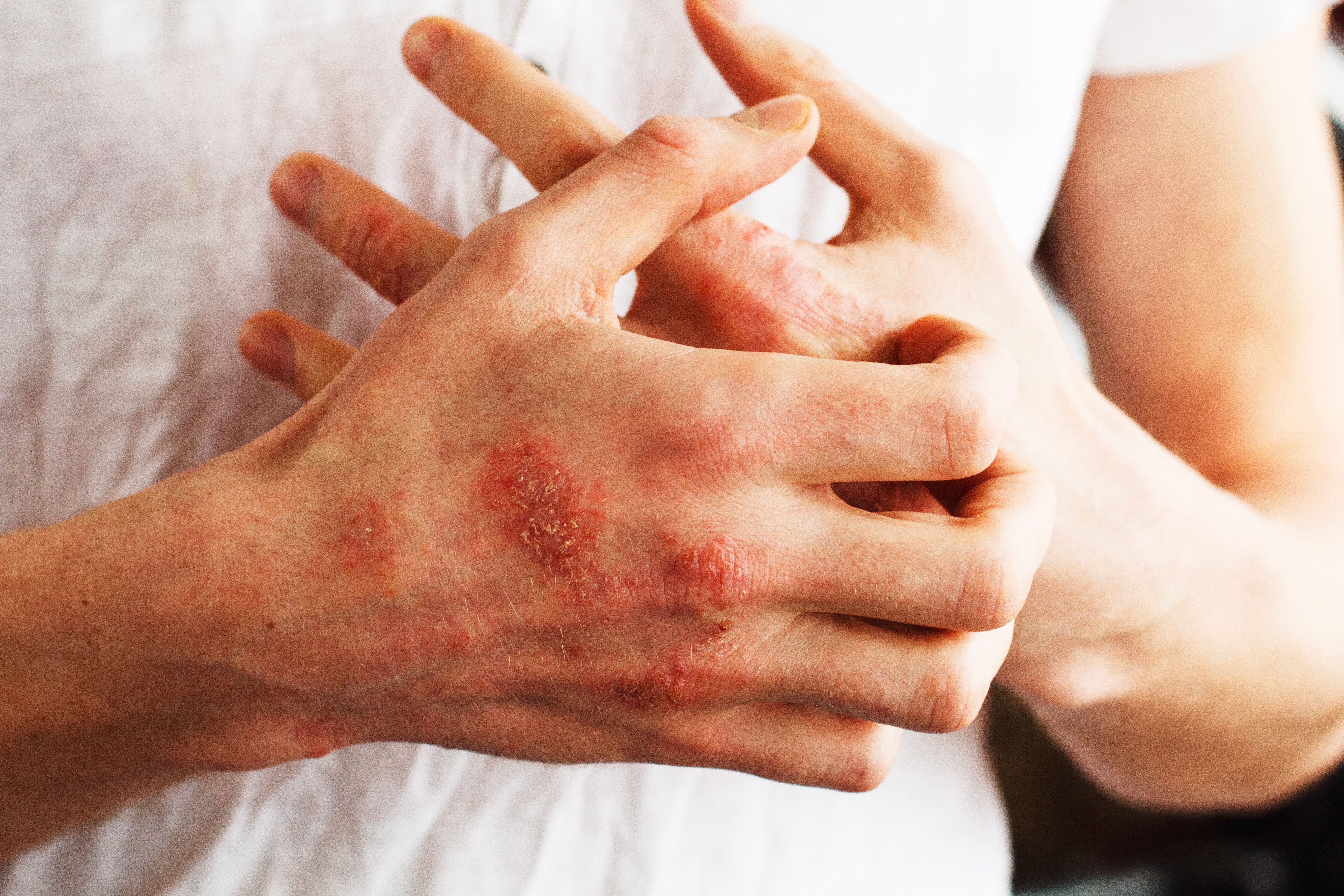Man scratch oneself, dry flaky skin on hand with psoriasis vulgaris, eczema and other skin conditions like fungus, plaque, rash and patches. Autoimmune genetic disease - Image credit: Ольга Тернавская | stock.adobe.com